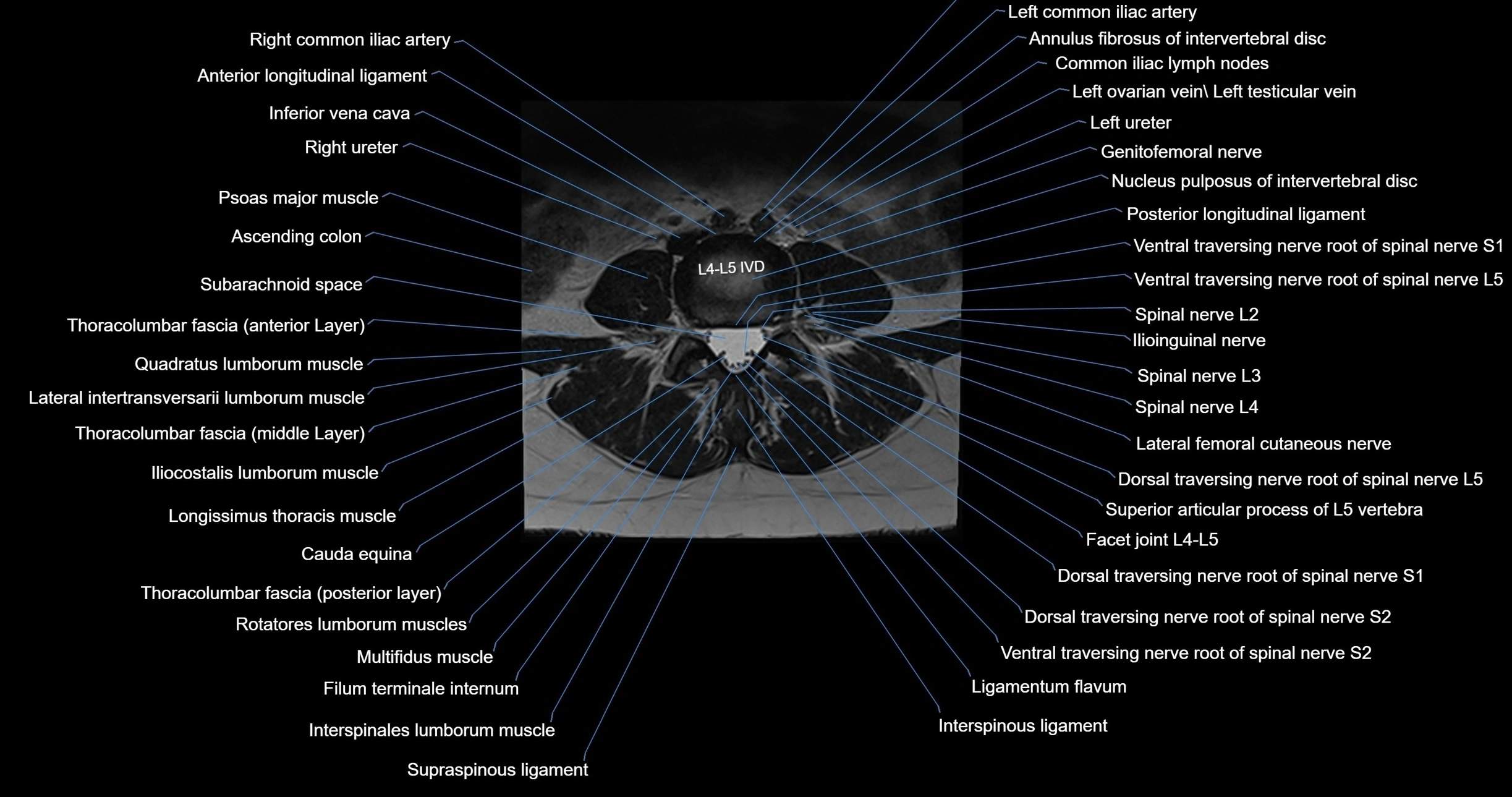 MRI lumbar spine axial cross sectional anatomy 3T radiology  image-img-00001-00035.webp